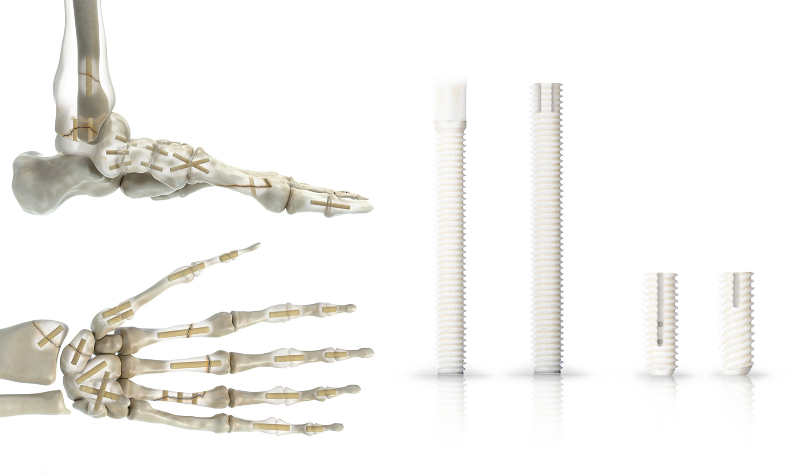 „Shark Screw”-Varianten. Knochenschrauben sind gut geeignet für Operationen an Hand und Fuß. 