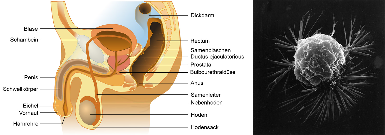 links: Lage der Prostata, rechts: Brustkrebszelle unter einem Raster­elektronen­mikroskop